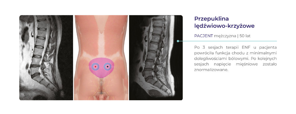 terapia ENF - dowody kliniczne