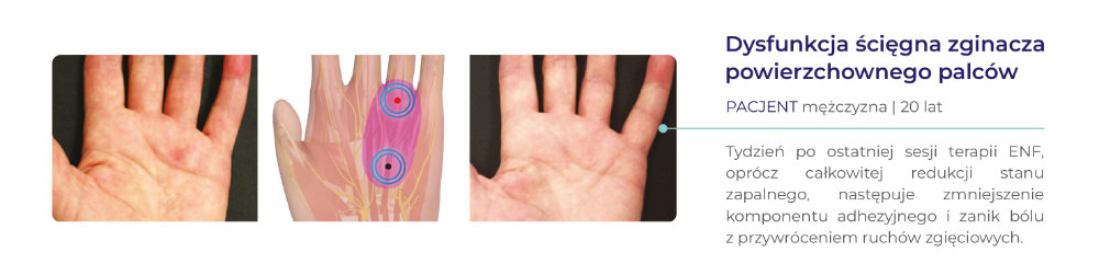 terapia ENF - dowody kliniczne