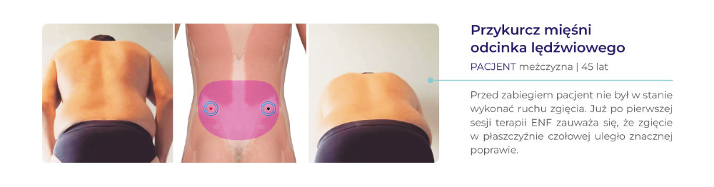 terapia ENF - dowody kliniczne