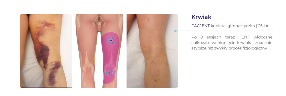 terapia ENF - dowody kliniczne