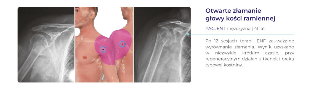 terapia ENF - dowody kliniczne