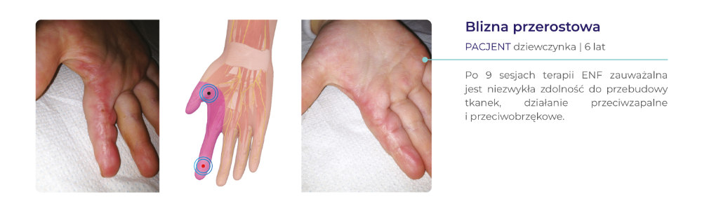 terapia ENF - dowody kliniczne