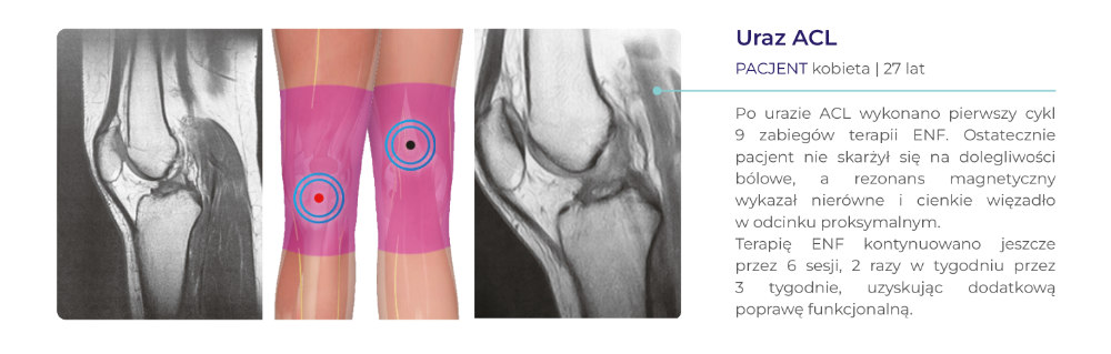 terapia ENF - dowody kliniczne