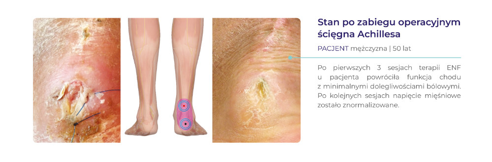 terapia ENF - dowody kliniczne