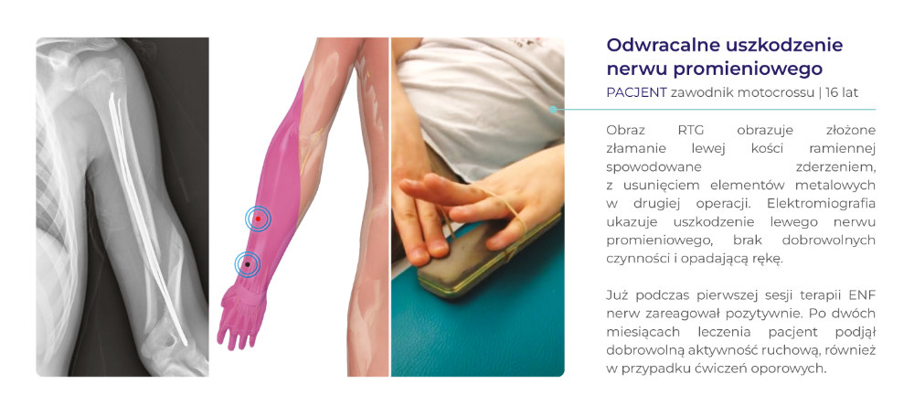 terapia ENF - dowody kliniczne
